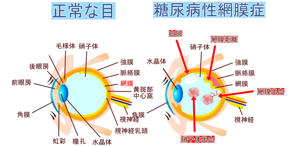 糖尿病性網膜症