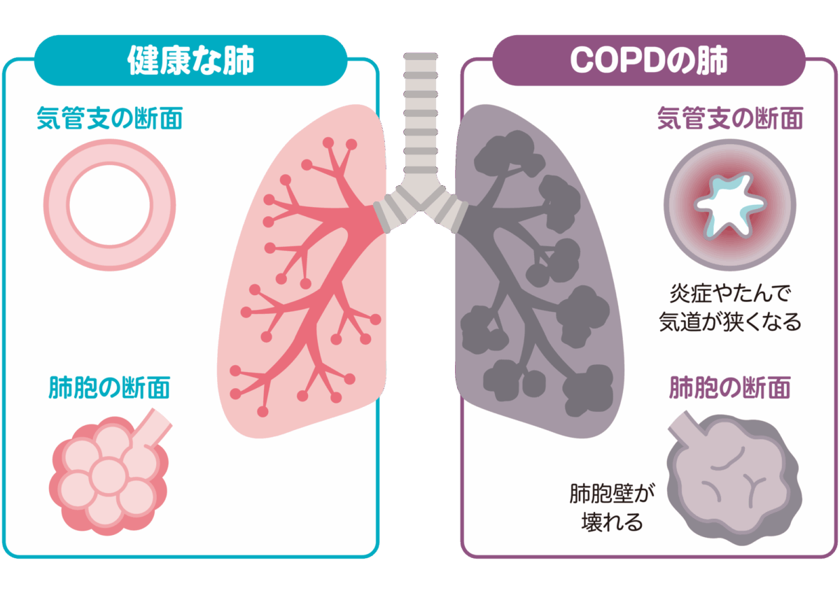 COPD