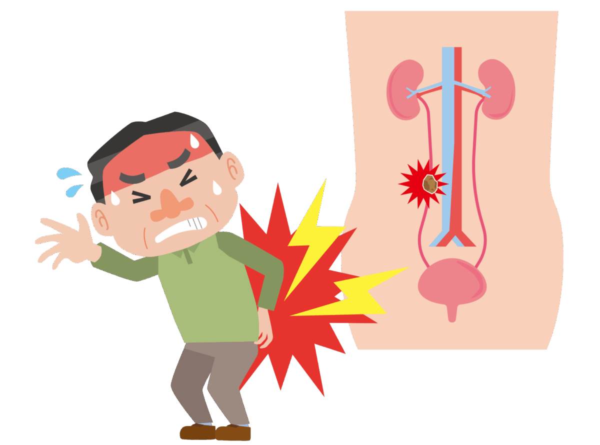 尿管結石イメージ